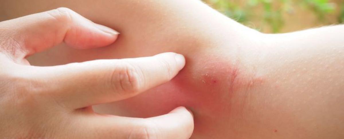 Rode jeukende bultjes? Bel de huisarts!